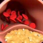 Clogged Arteries Not Just A Problem Of Modern Diet