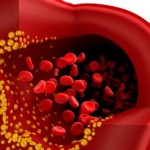 Lipid may Prevent Heart Disease by Softening Arteries