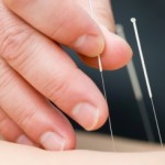 The Many Forms of Acupuncture to Treat Arthritis