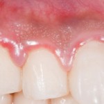 Is Gum Disease Linked To Rheumatoid Arthritis?
