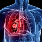 Lung Cancer: Can You Get It Without Smoking?