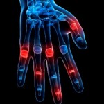 How to Reduce Your Risks of Rheumatoid Arthritis
