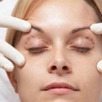 Can You Have a Facelift Without Surgery?