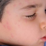 Measles Epidemic is on the Rise in Swansea Area