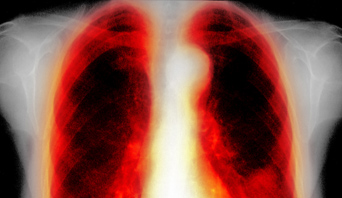 sb10067350a-001_pneumonia-342x198