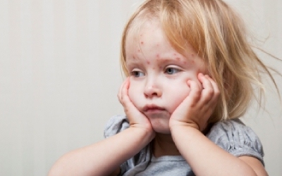 measles
